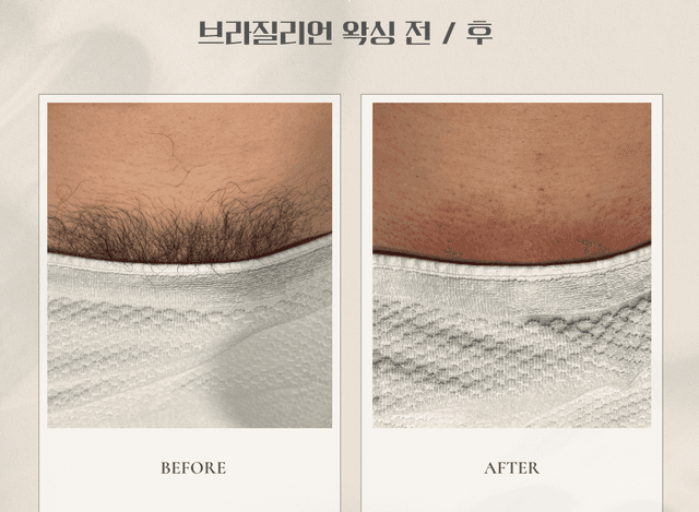 남자 브라질리언 고급(올누드)