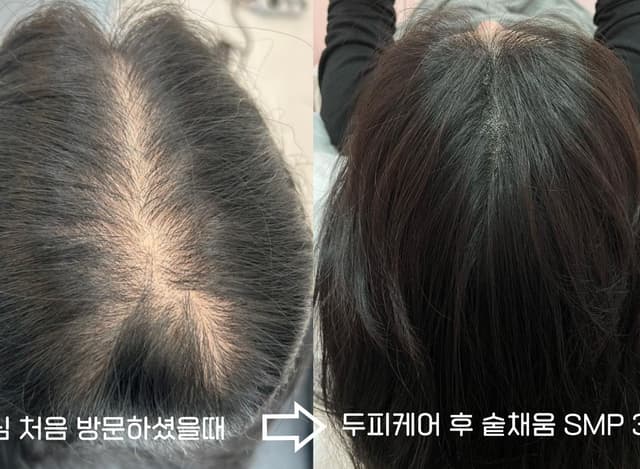 정수리SMP