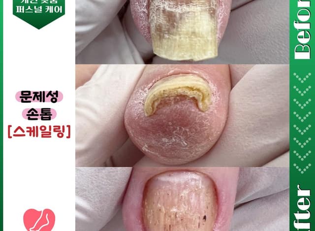 문제성 손톱 