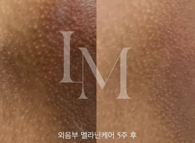 외음부