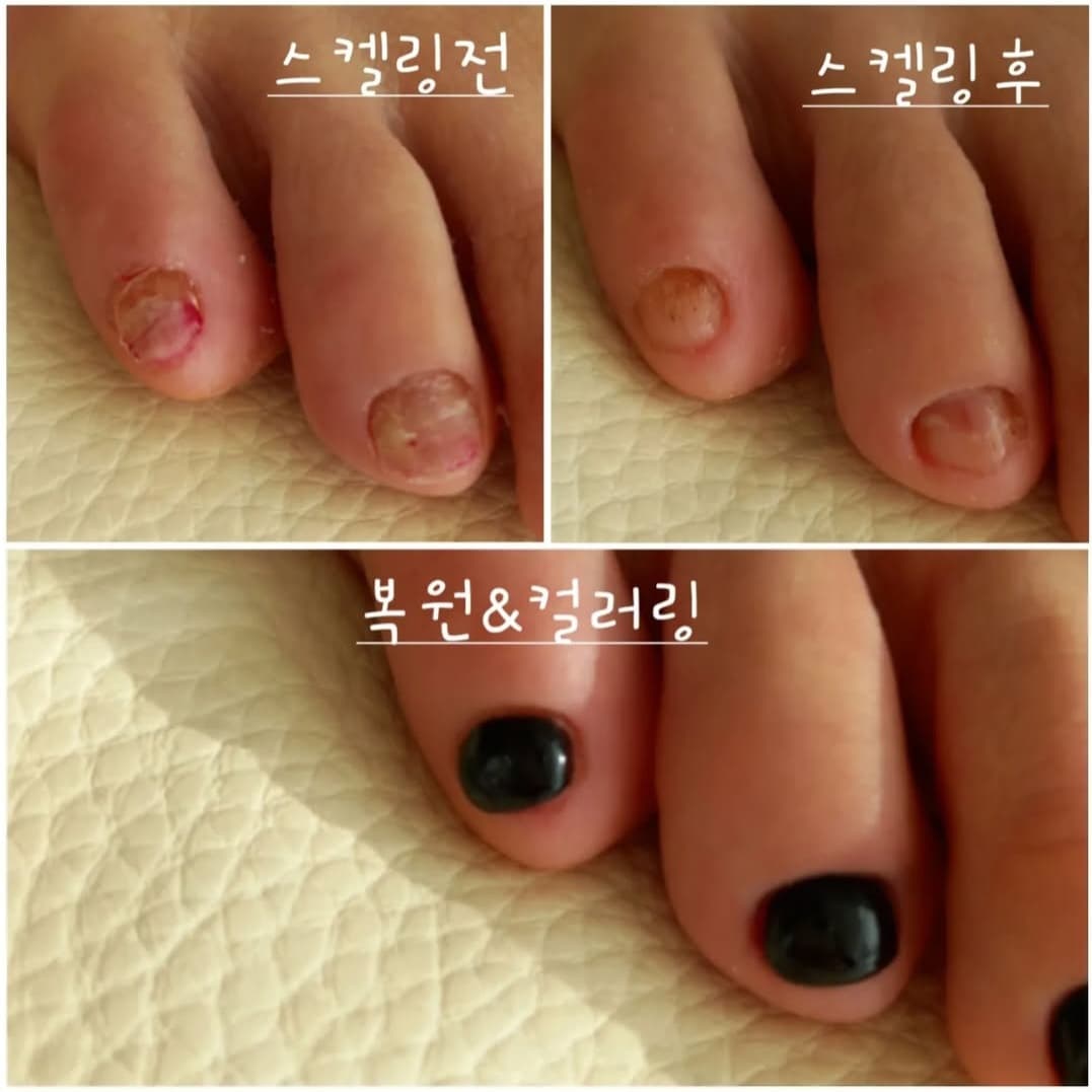 무좀발톱관리