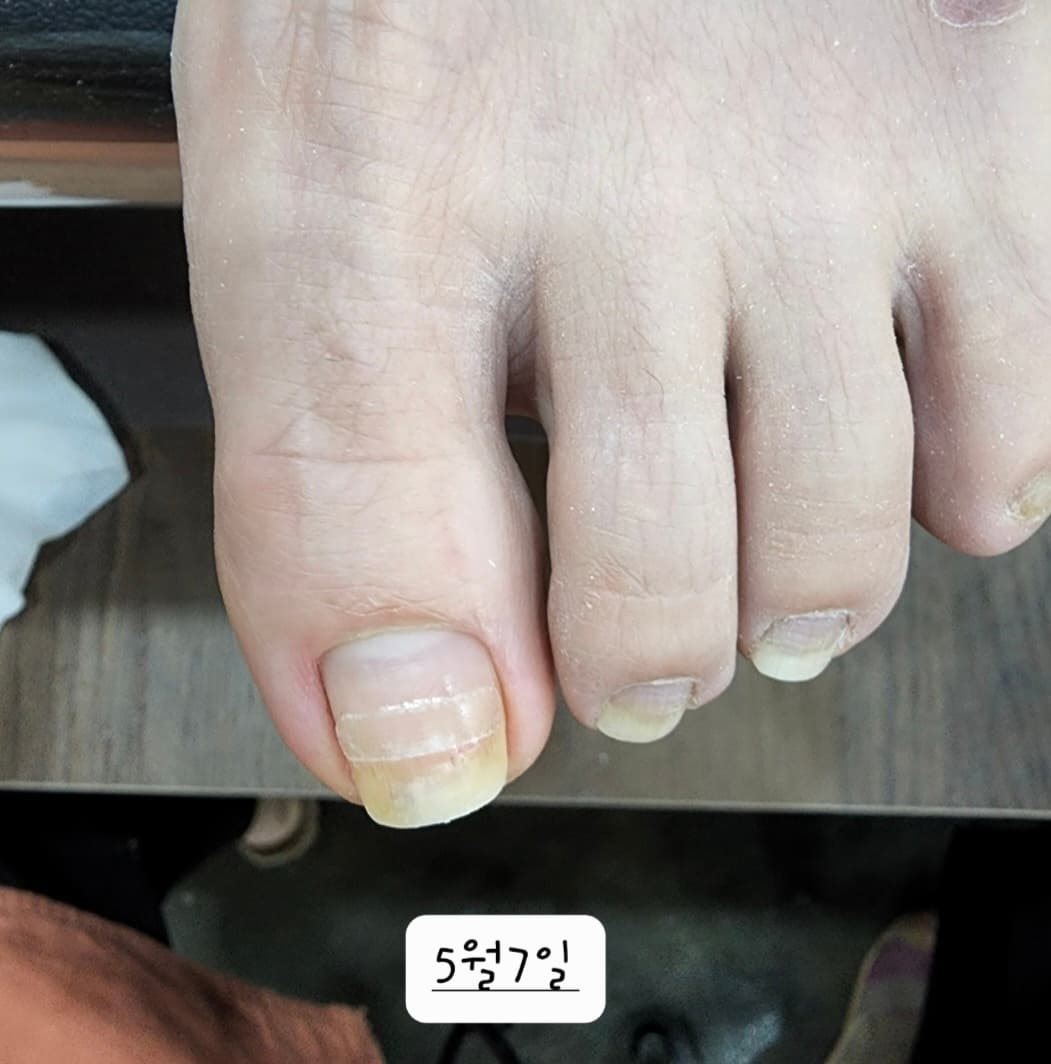 내성발톱(밴드)LCN