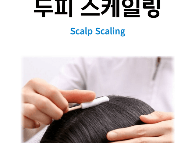 두피스케일링