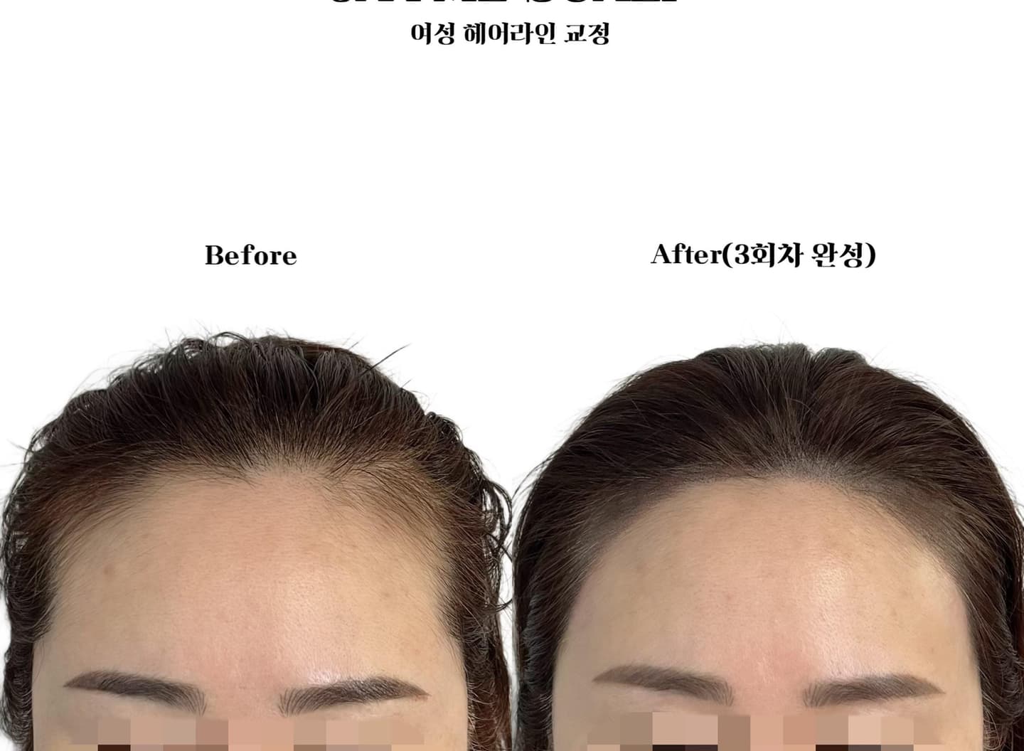 헤어라인