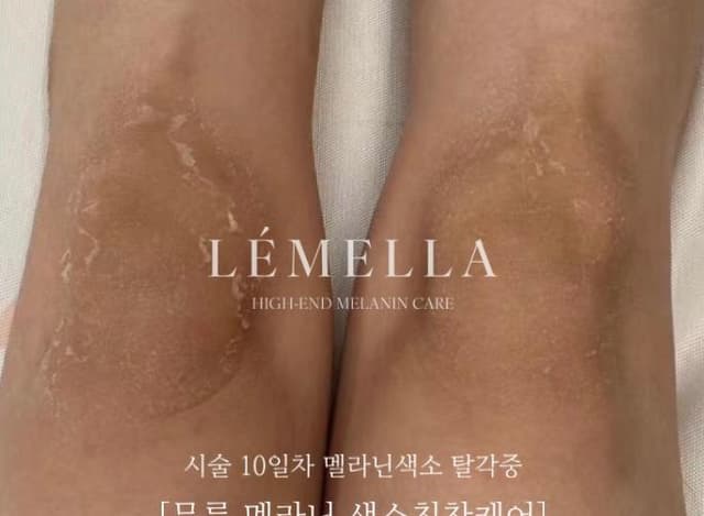 무릎