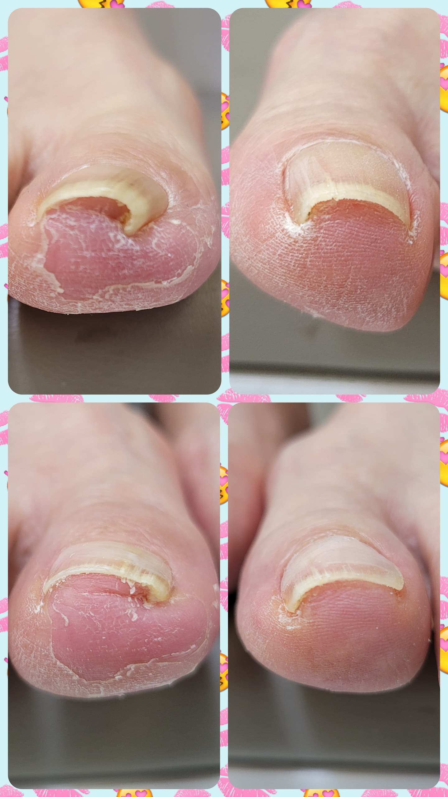 내성발톱(팁)엄지1개