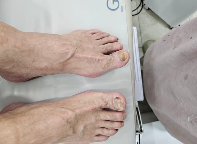 문제성발톱스켈링 열발