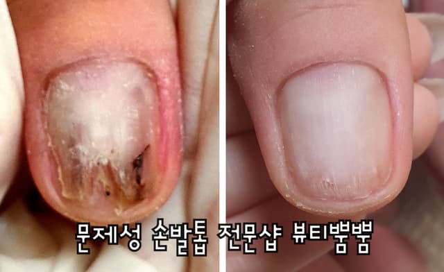 문제성 발관리