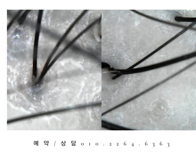 헤드스파 두피 스케일링관리 (베이직)