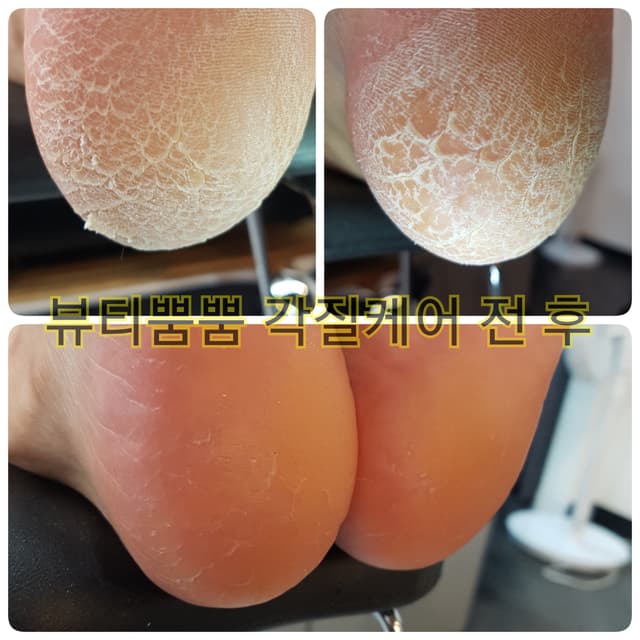 발각질 관리
