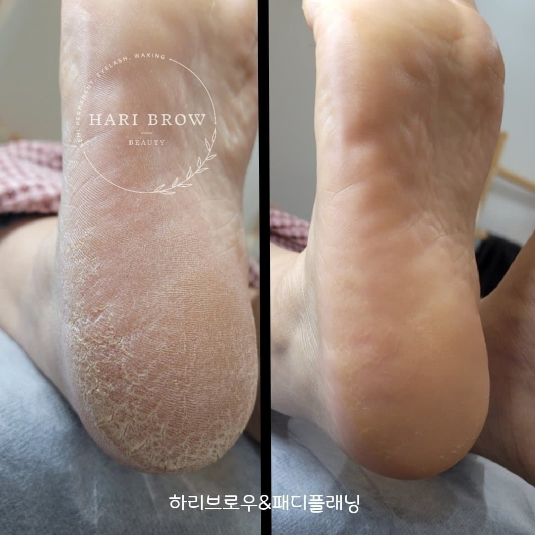패디플래닝(발각질제거)