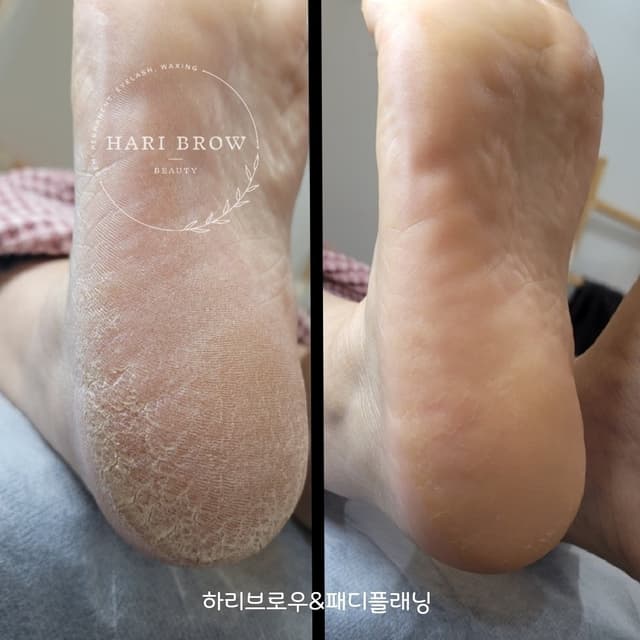패디플래닝(발각질제거)
