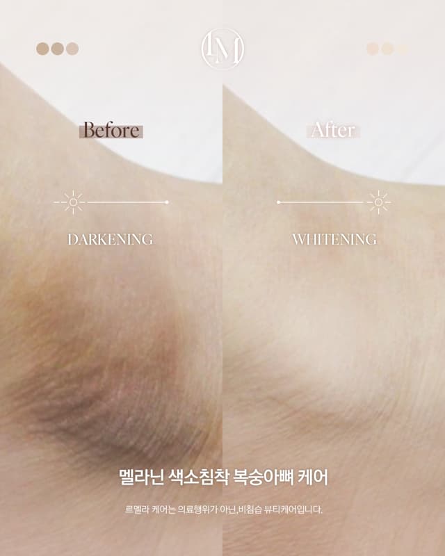 겨드랑이
