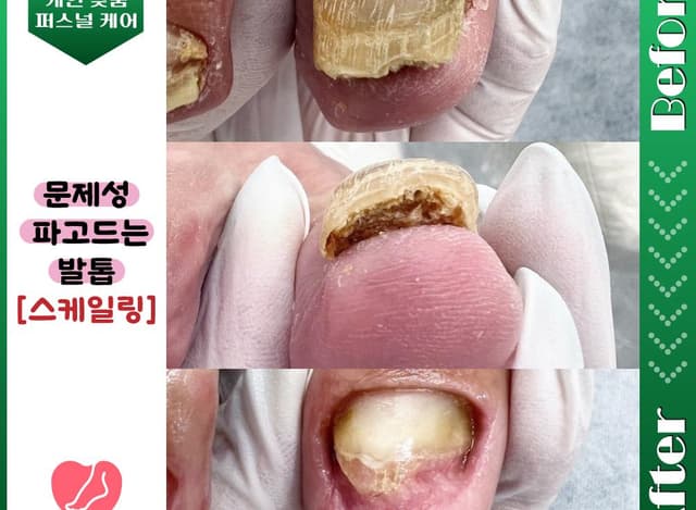 문제성 발톱 