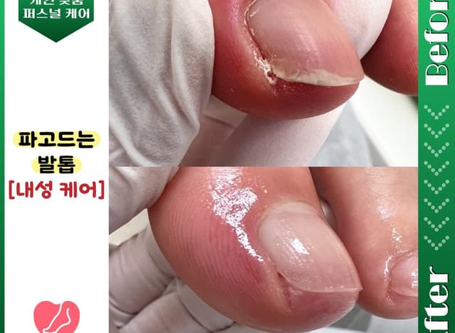 내성 예방 케어