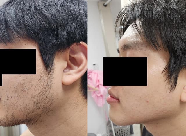 전체수염(인중, 턱, 진정포함)