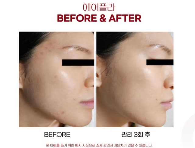 비립종.쥐젖.검버섯관리