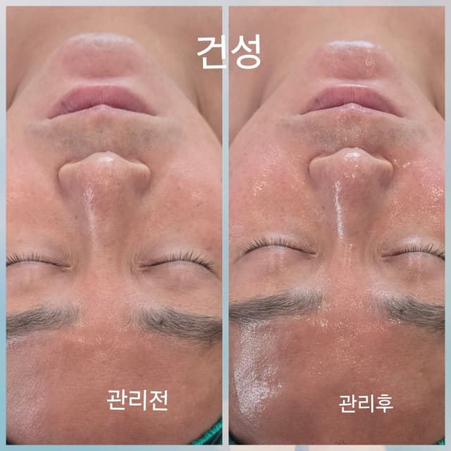 스킨컨디션케어(카복시 모공케어or 글로스케어)