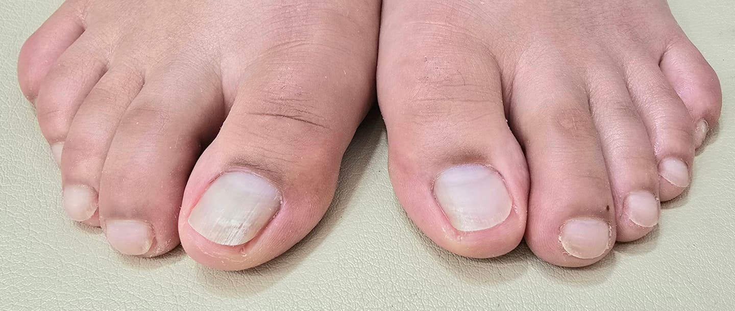 문제성케어 한쪽발