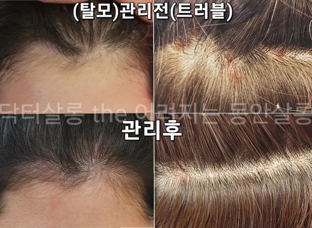 지루성케어+염증관리
