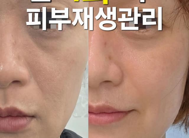 페이스관리(피부생장술)
