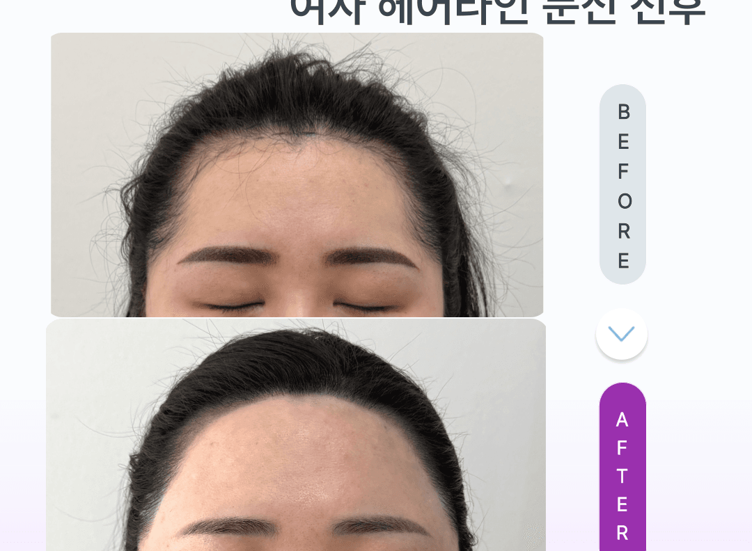 헤어라인문신 상담