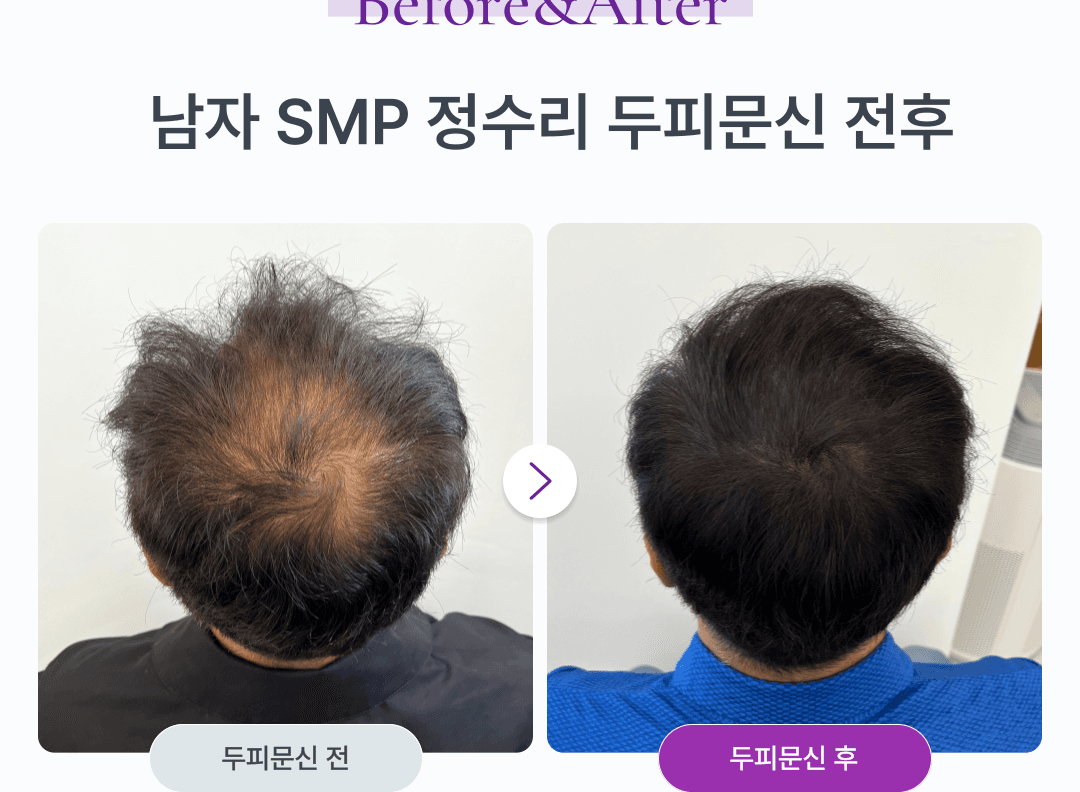 정수리문신 상담
