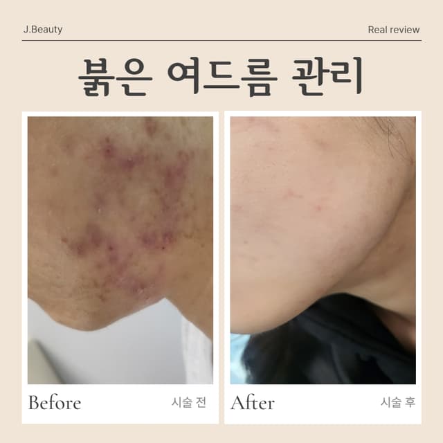여드름흉터관리
