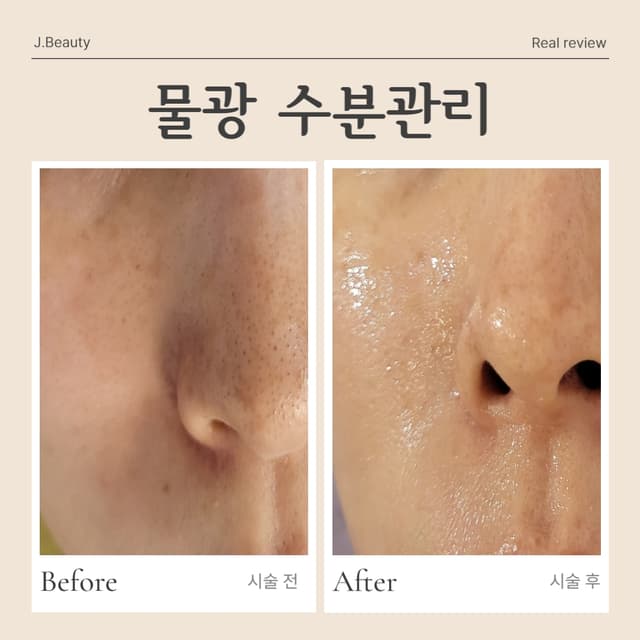 물방울 리프팅