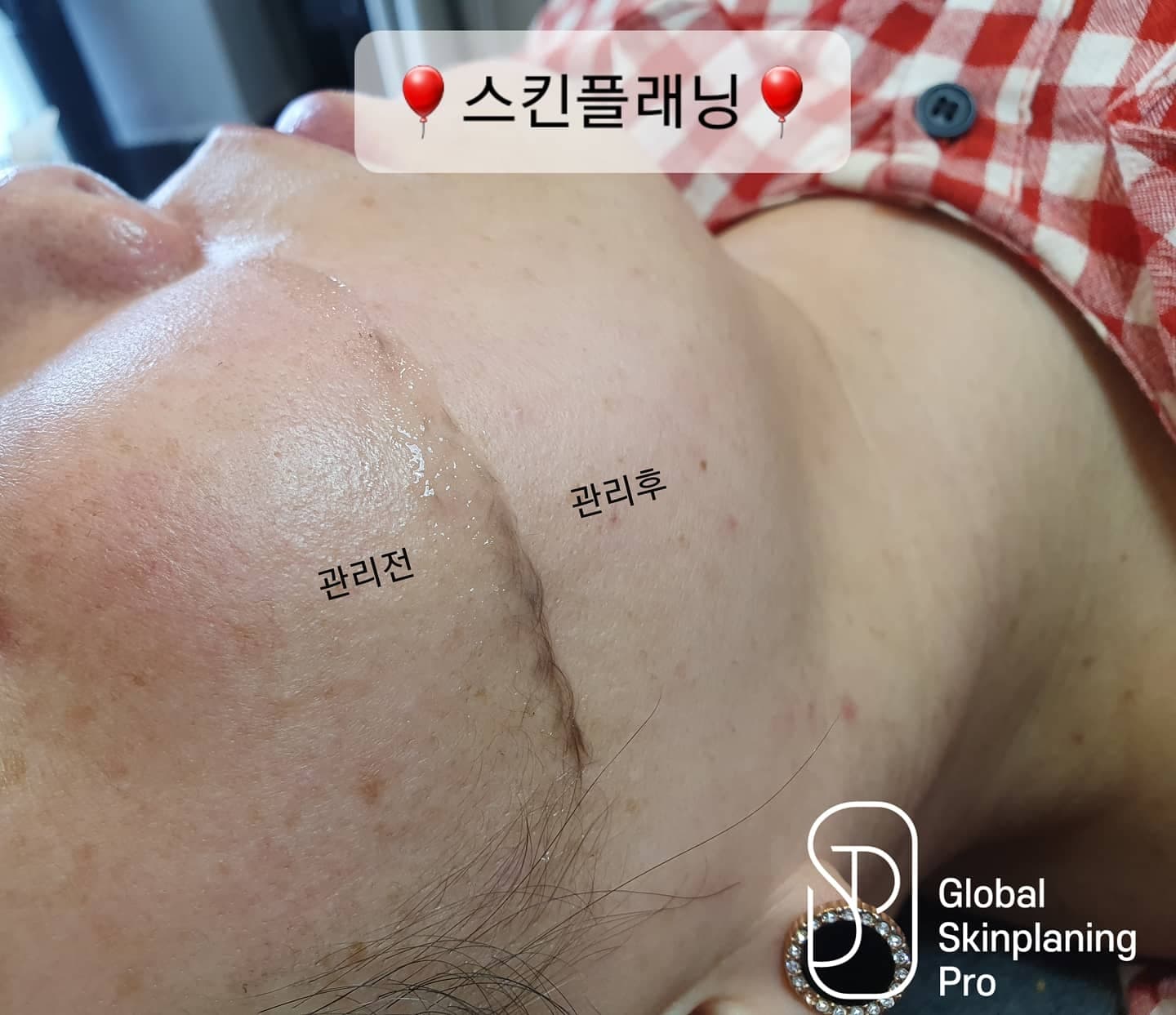스킨플래닝