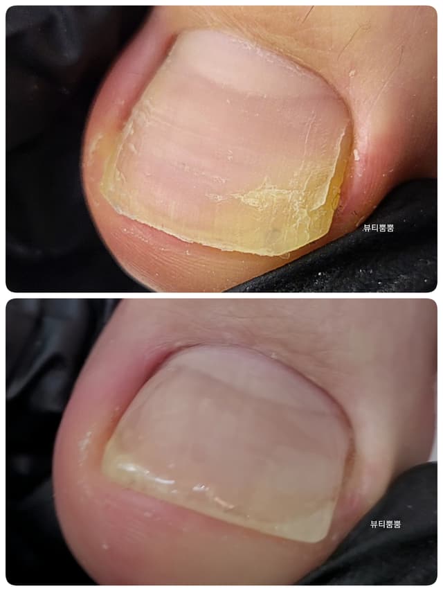 문제성 손관리