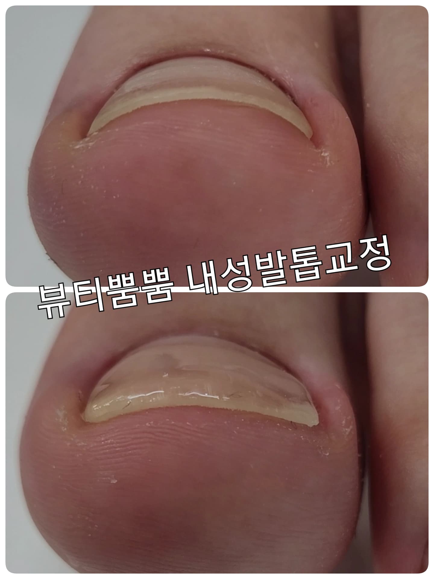 내성발톱교정