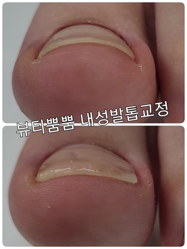 내성발톱교정