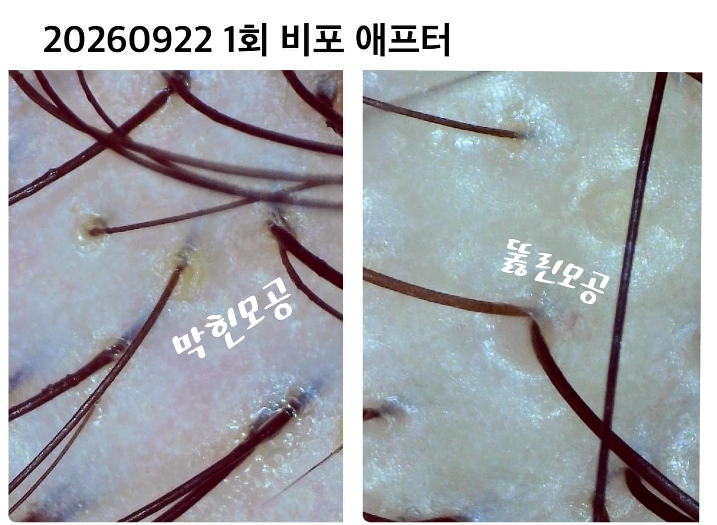 두피스켈링