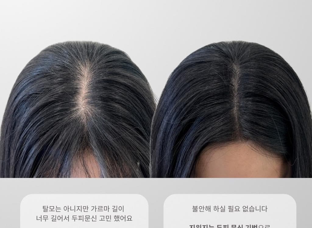 두피 숱채움(소레아)