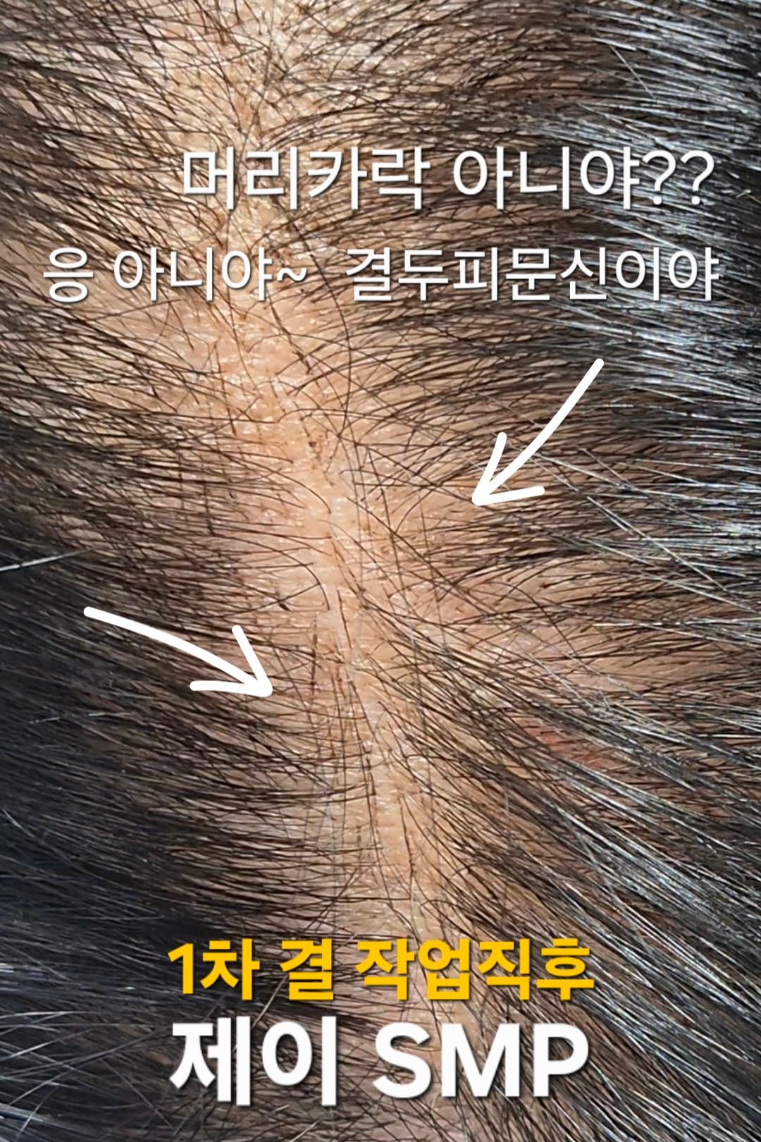 LSMP정수리 3D결표현(지름10cm부터)