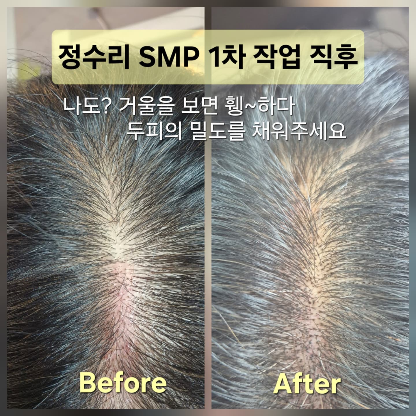 SMP 정수리 도트(지름10cm부터)