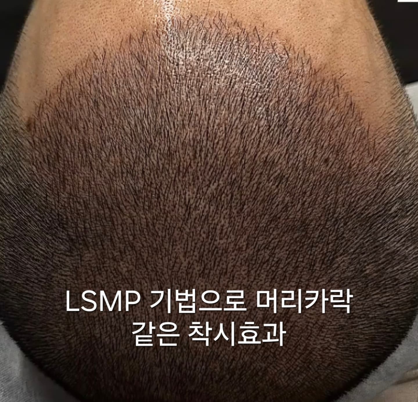 LSMP 삭발형-3D결 3mm