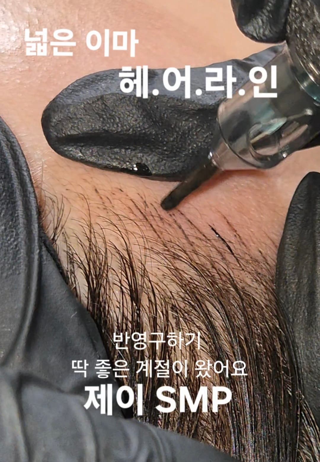 LSMP 헤어라인(스트록+도트)