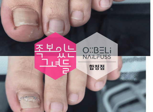 나겔플락(내성발톱와이어)